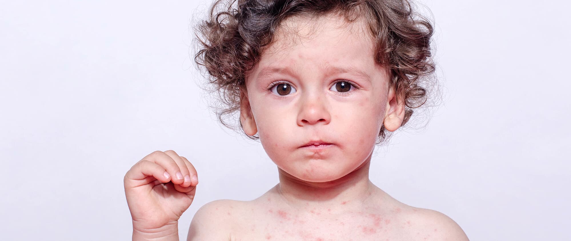 Quelles sont les conséquences d’une allergie ?